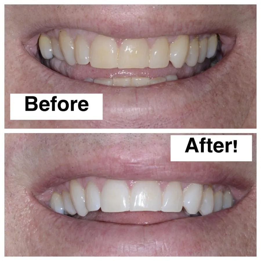 24898 seattle teeth whitening procedure