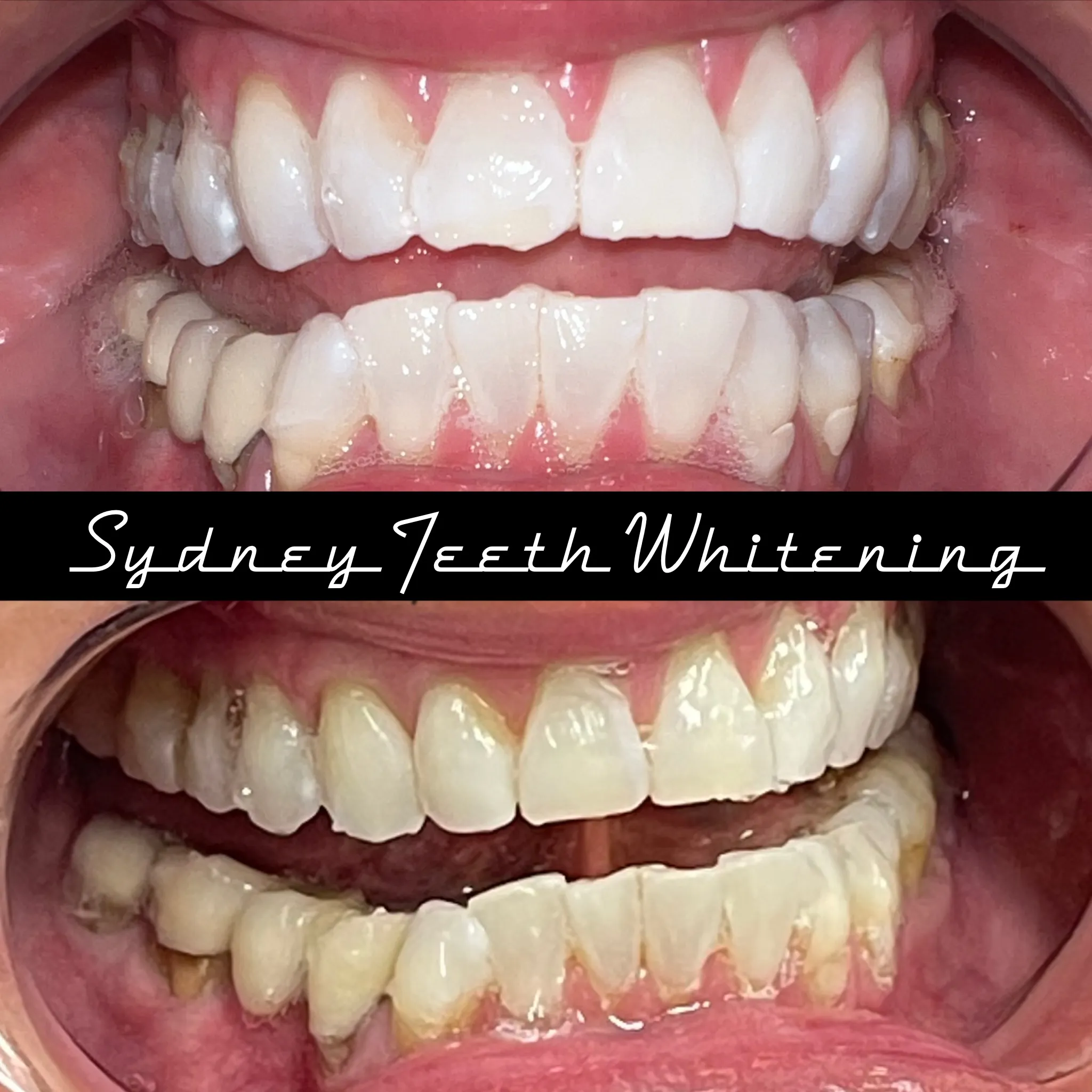 24898 seattle teeth whitening results