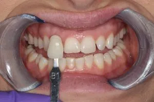 24899 artificial colors teeth whitening
