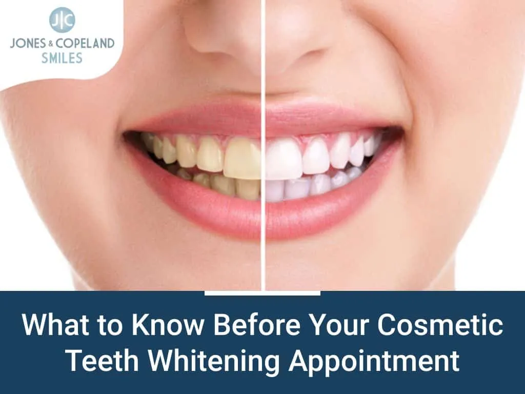 24909 teeth whitening consultation