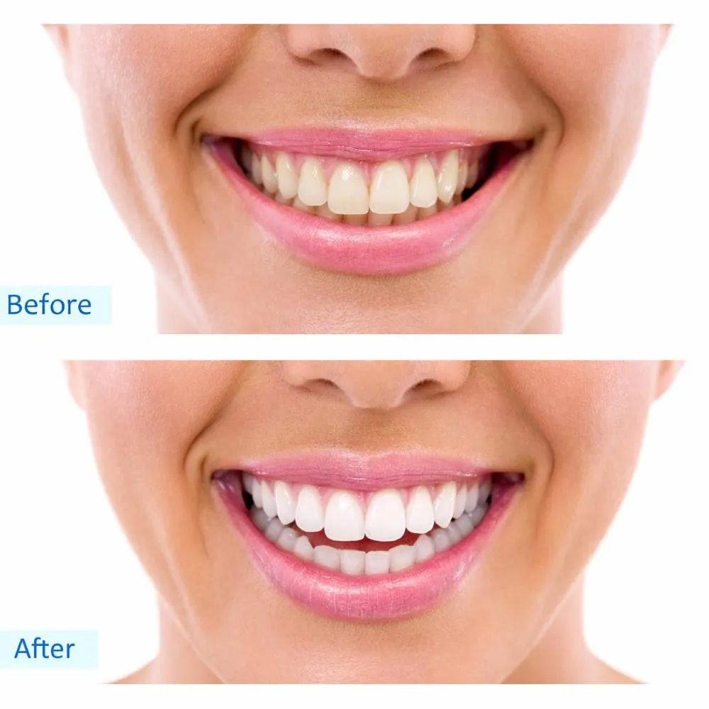 24913 teeth whitening before after