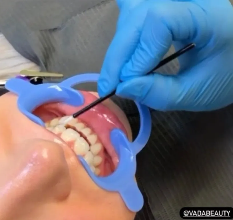 24919 in office teeth whitening