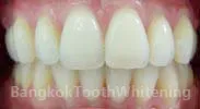 24920 bangkok tooth whitening clinic