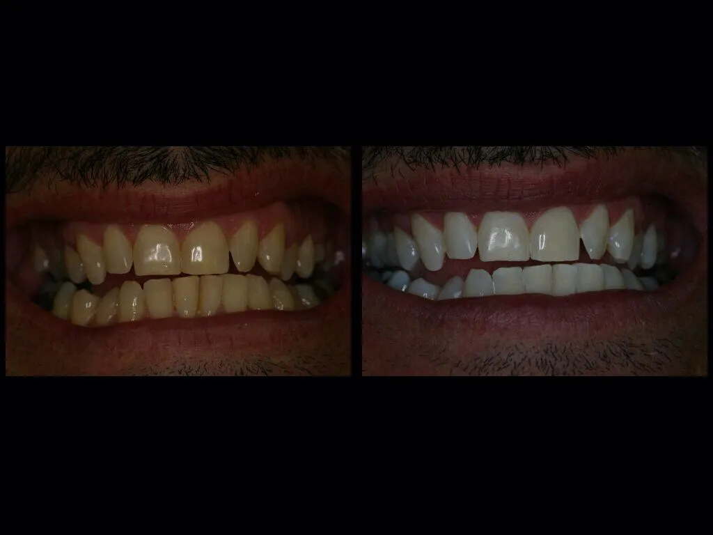 24921 zoom whitening candidates
