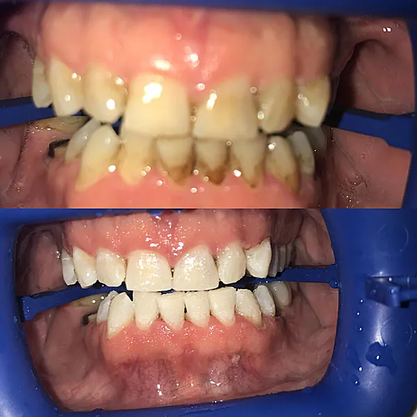 24921 zoom whitening cost