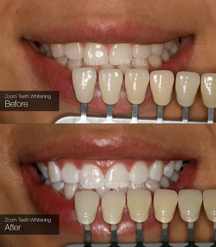 /img/24921-zoom-whitening-maintenance.webp