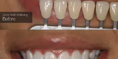 /img/24921-zoom-whitening-maintenance.webp