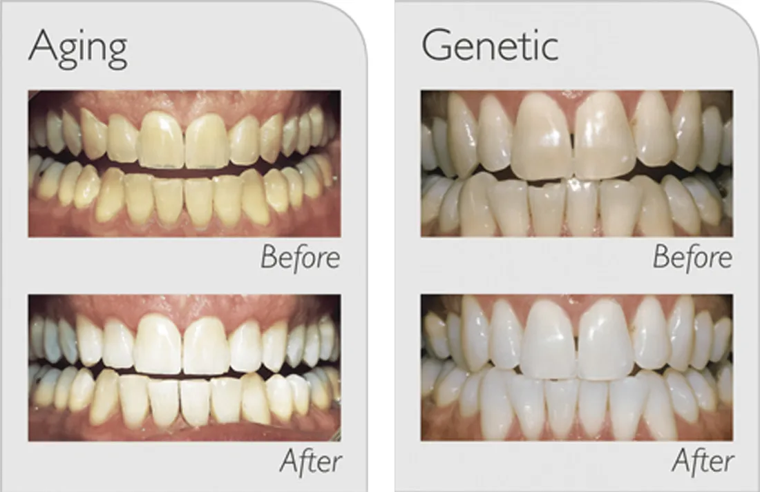 24921 zoom whitening sensitivity