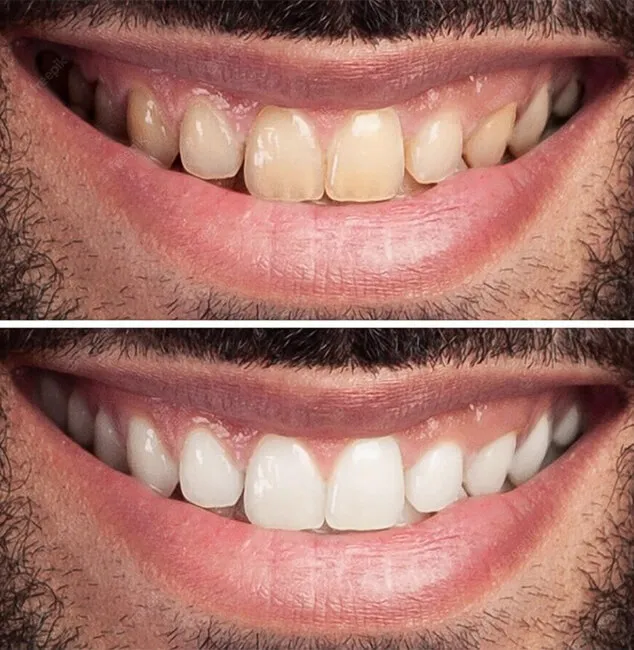 24925 at home teeth whitening