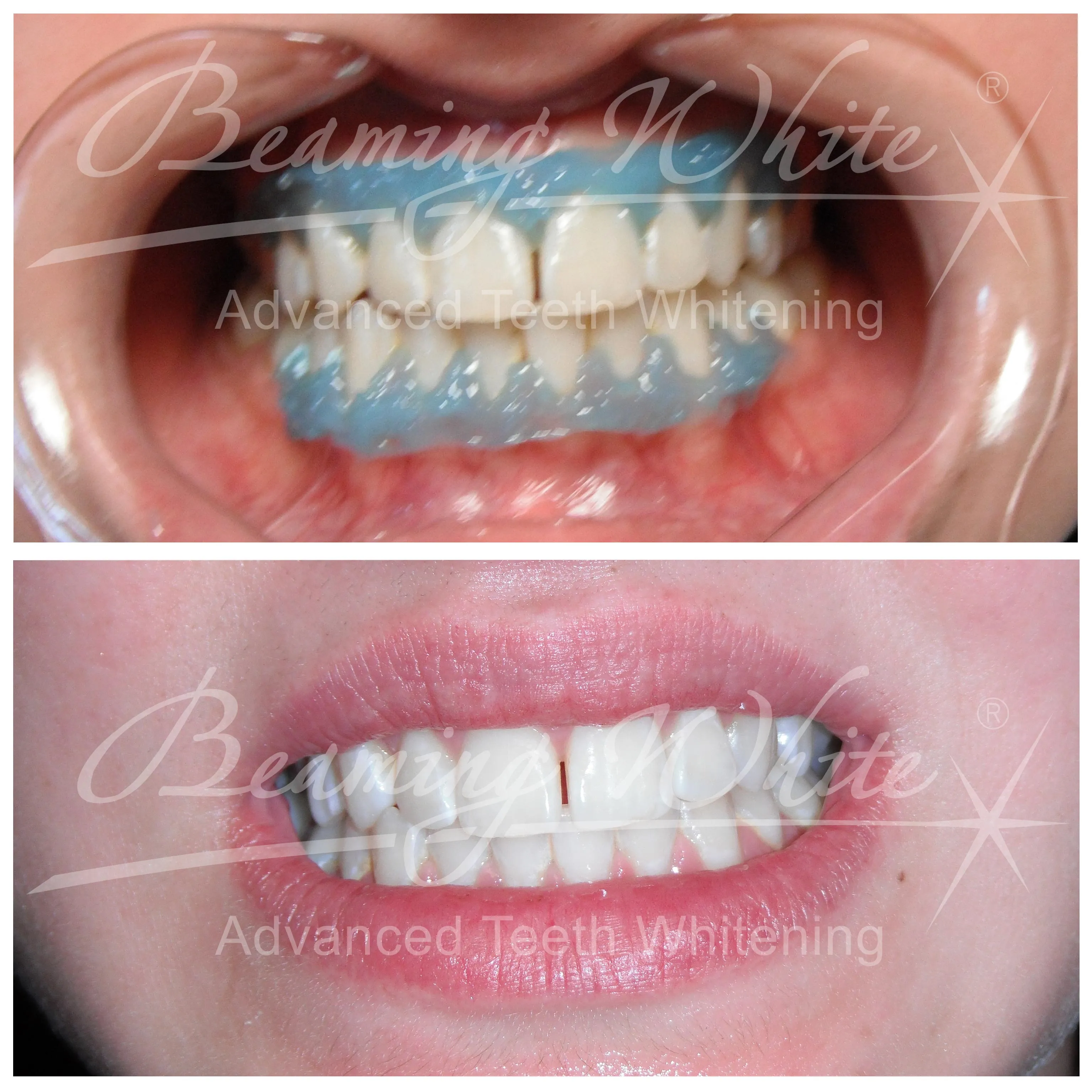 24925 teeth whitening picture tips
