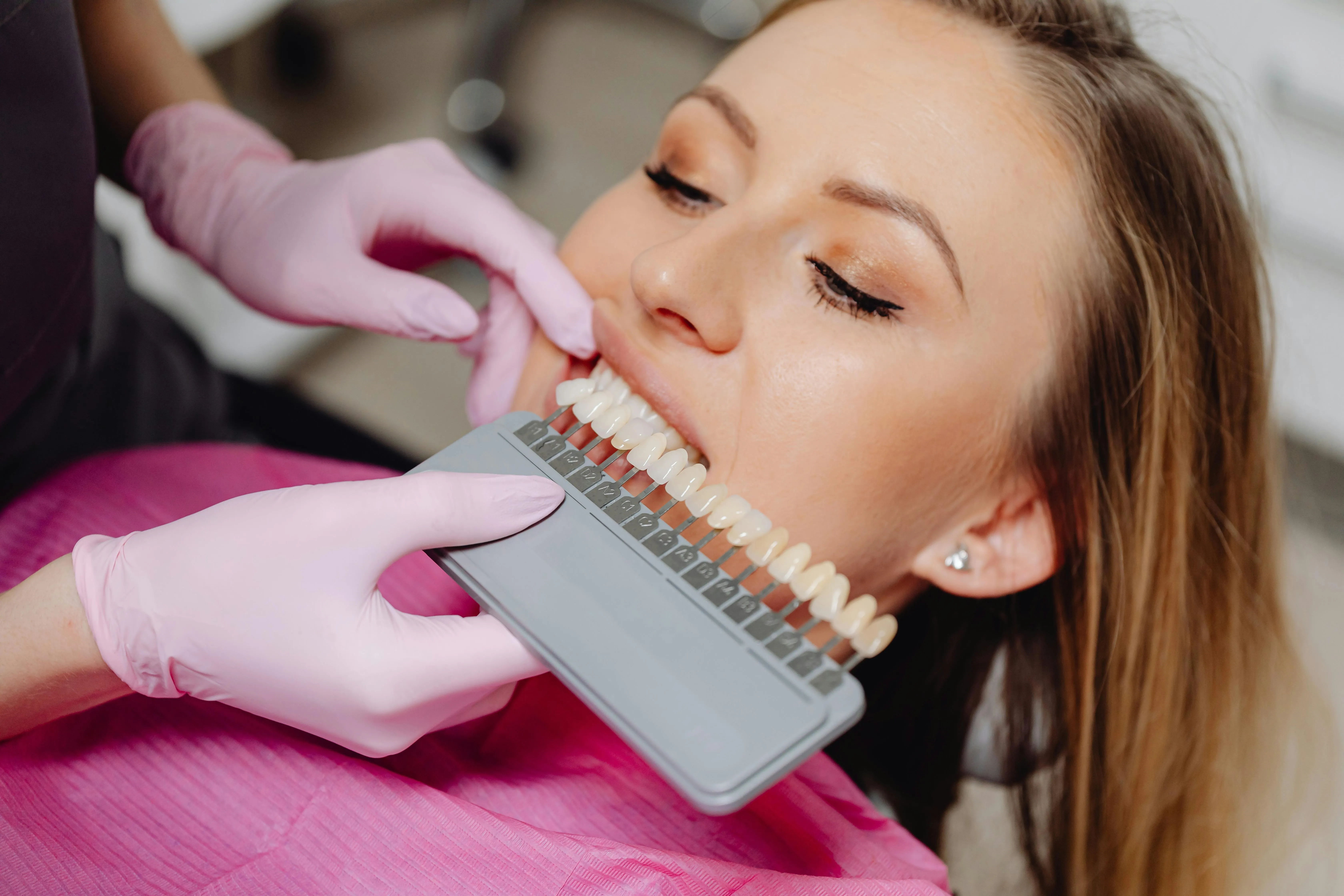 24925 teeth whitening results