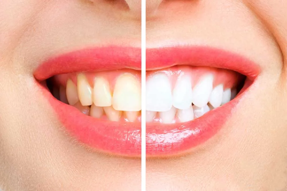 24929 at home teeth whitening welland