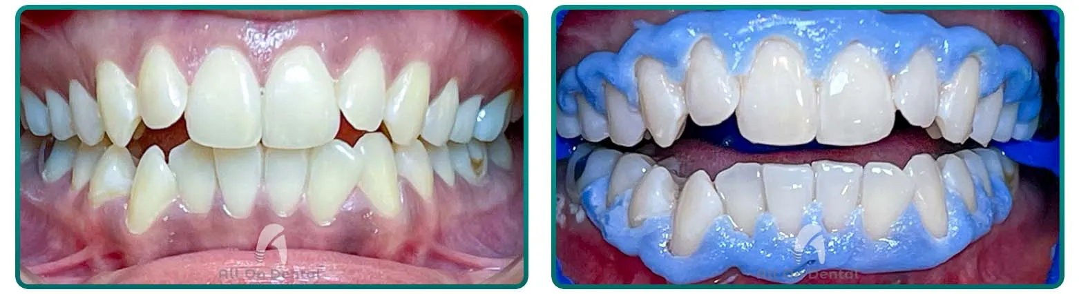 24929 staining foods teeth welland