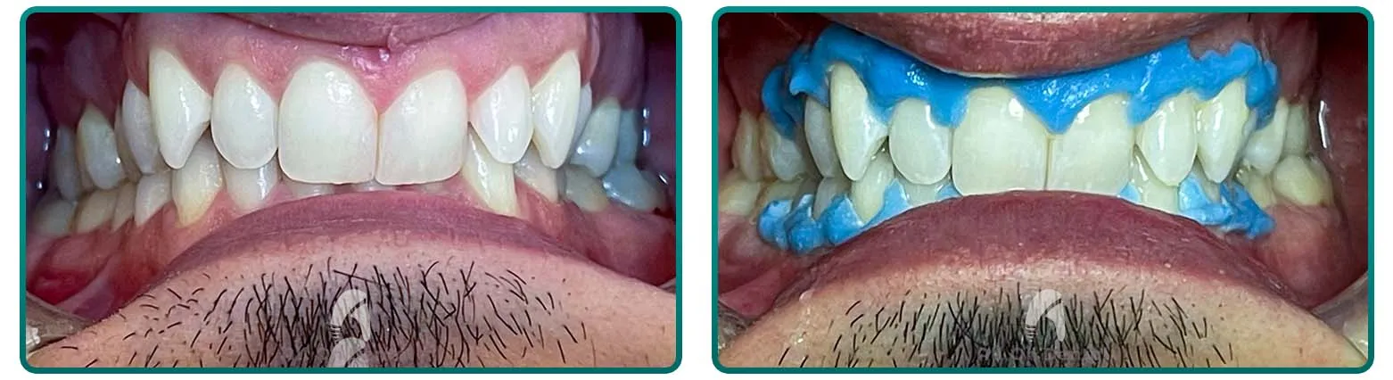 /img/24929-teeth-whitening-cost-welland.webp
