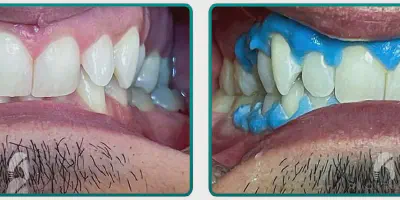 /img/24929-teeth-whitening-cost-welland.webp
