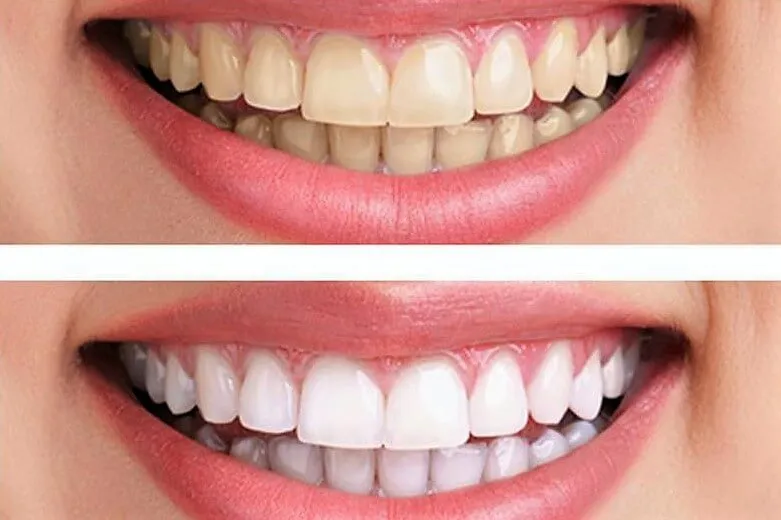 24930 baking soda teeth whitening 2