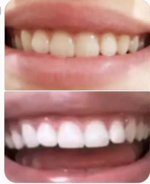 24933 teeth whitening gilbert az image3