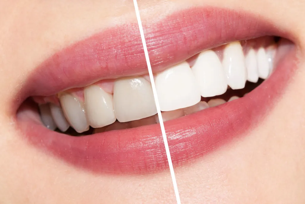 24935 at home teeth whitening