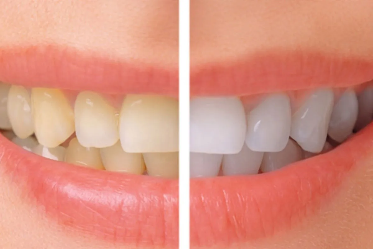 24935 in office teeth whitening