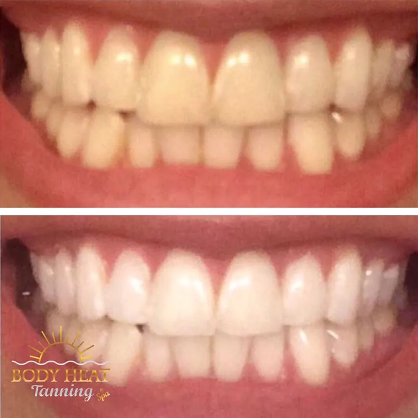 24935 teeth whitening maintenance