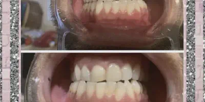 /img/24935-teeth-whitening-products.webp