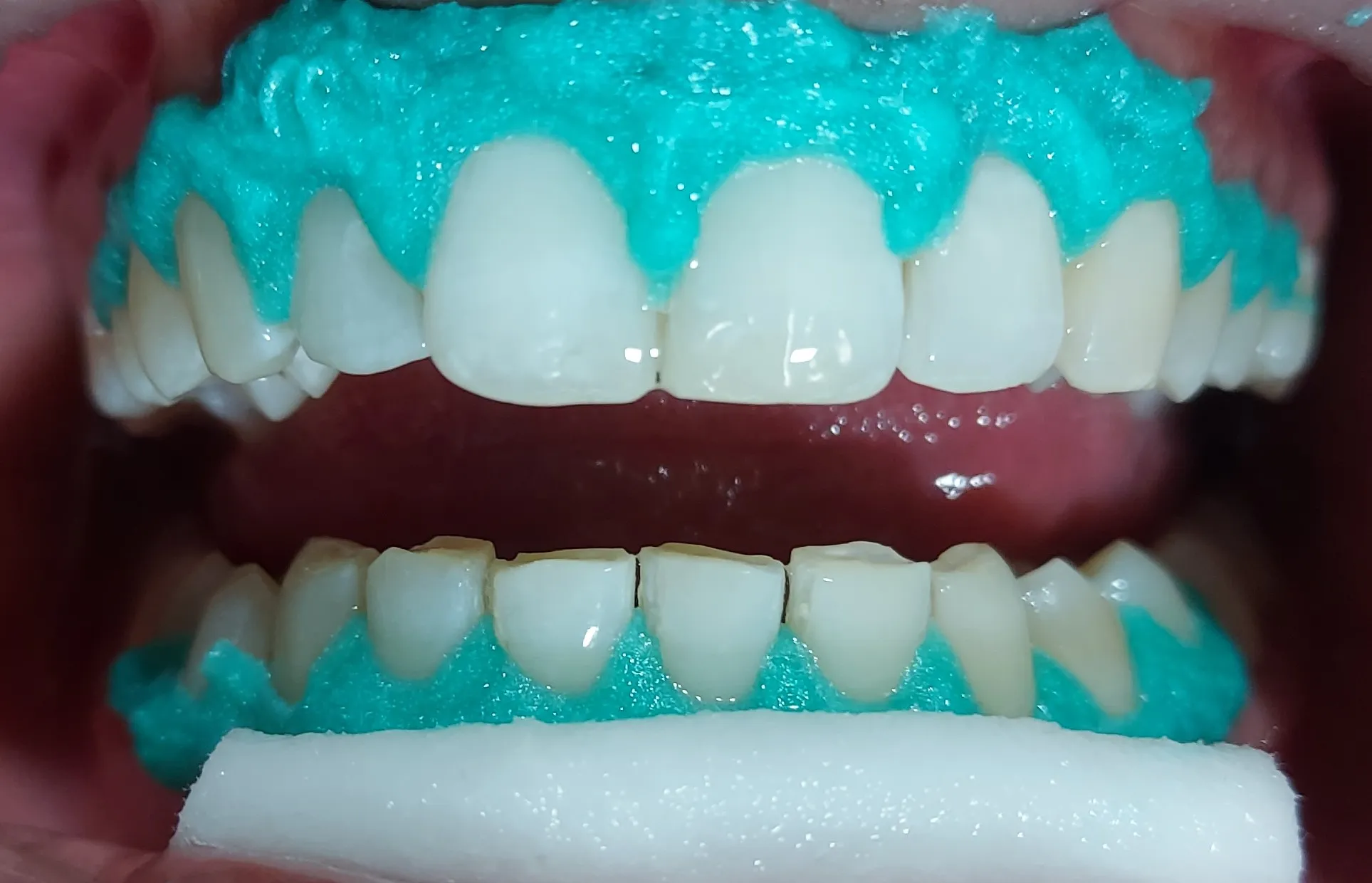 24935 teeth whitening sensitivity