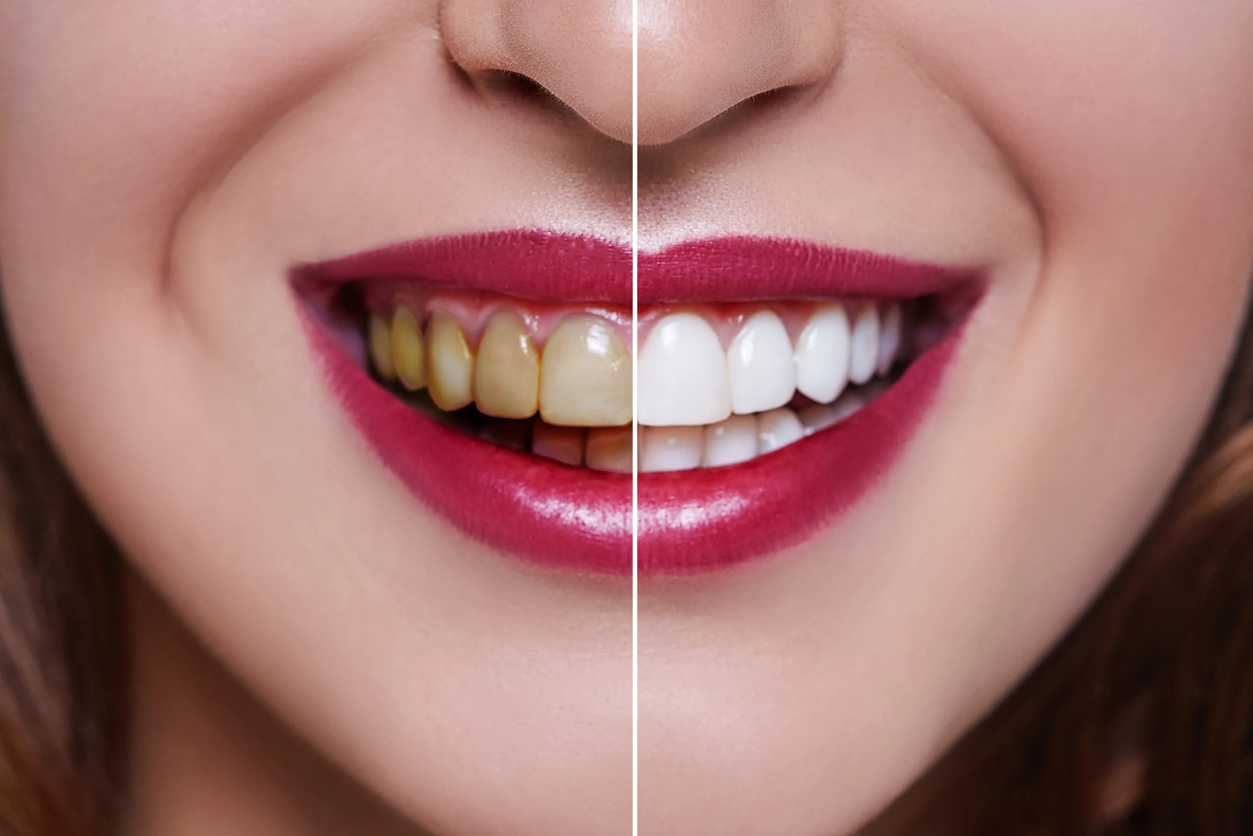 24940 professional whitening