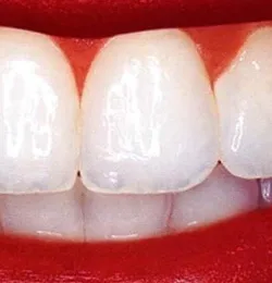 24944 teeth whitening chicago il image1