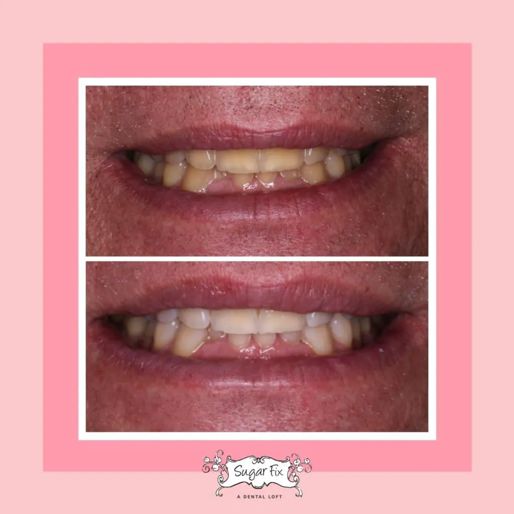 24944 teeth whitening chicago il image4