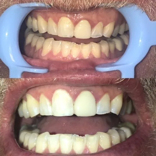 24945 at home teeth whitening kits