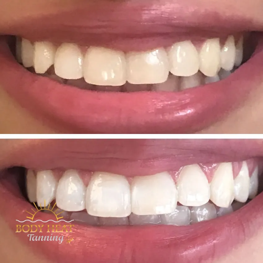 24945 teeth whitening sensitivity