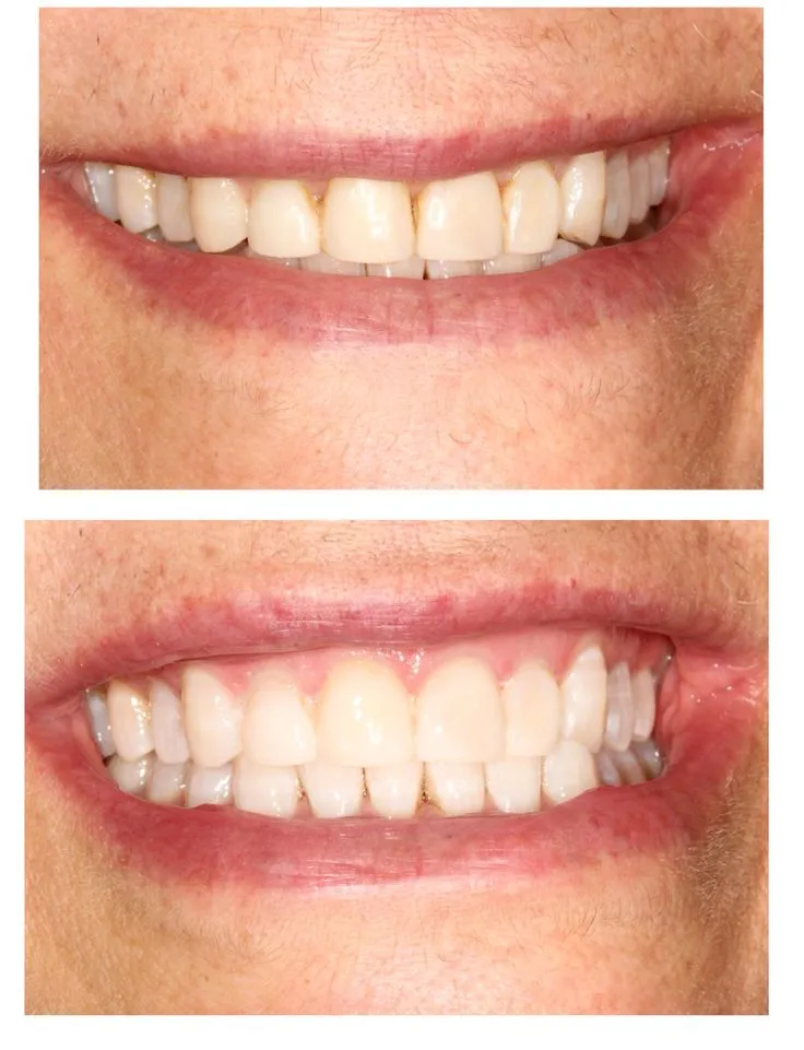 24946 zoom whitening aftercare 6