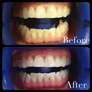/img/24948-professional-teeth-whitening.webp