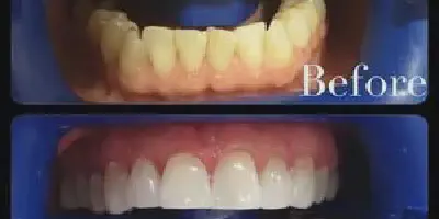 /img/24948-professional-teeth-whitening.webp