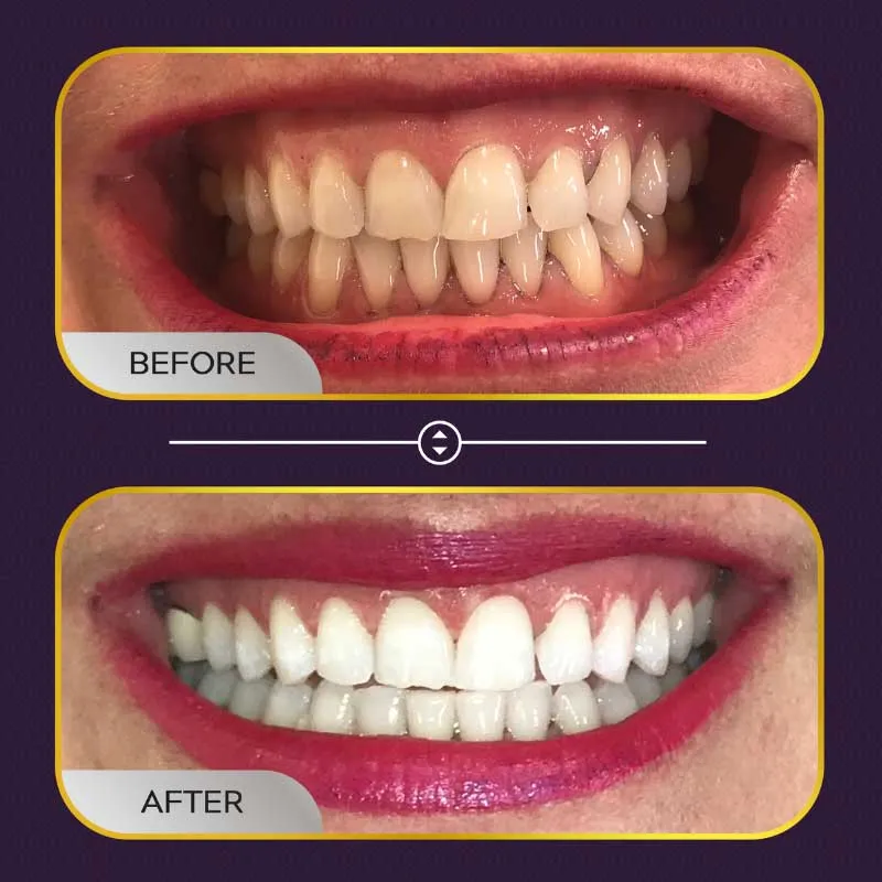 24950 teeth whitening methods