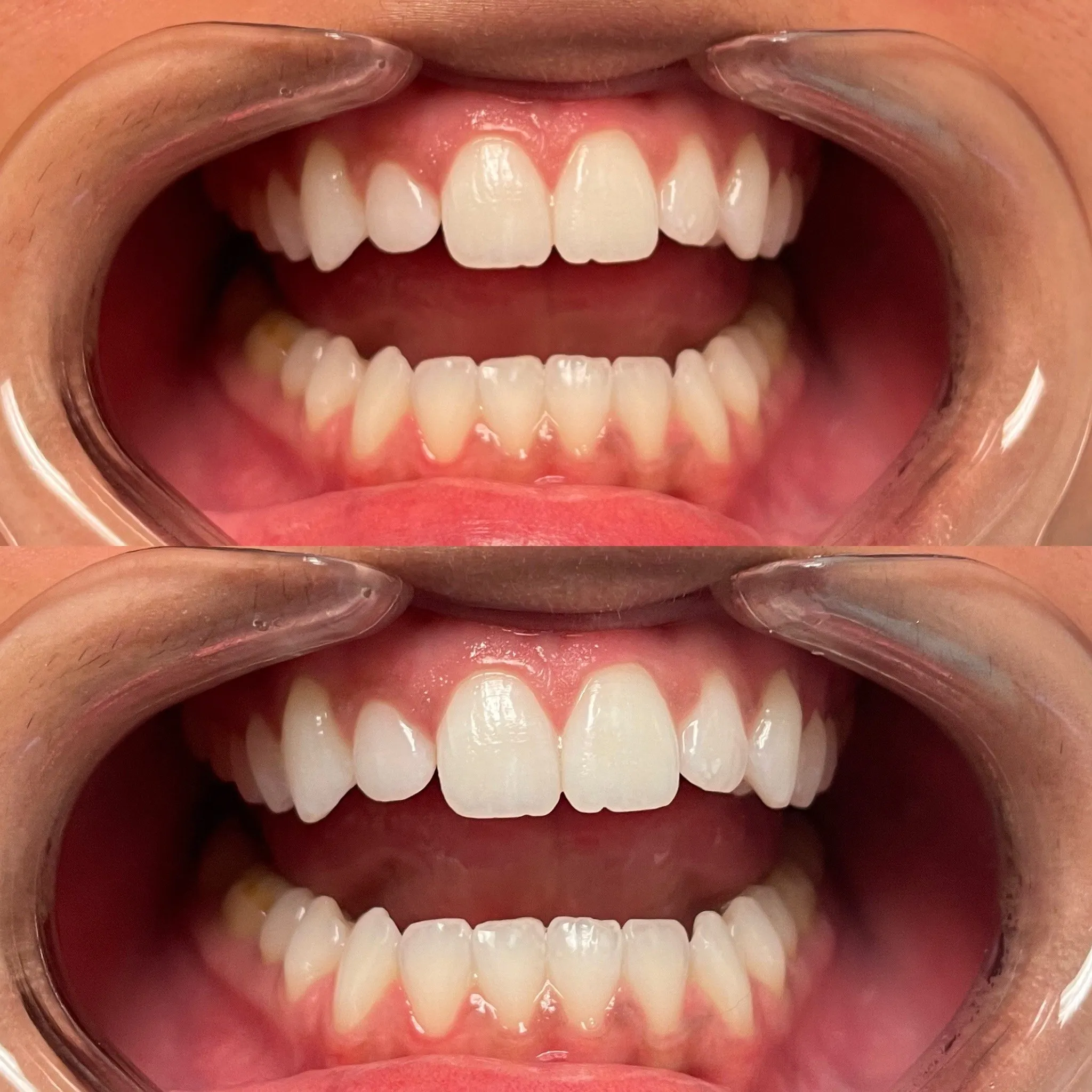 24951 strawberries teeth whitening
