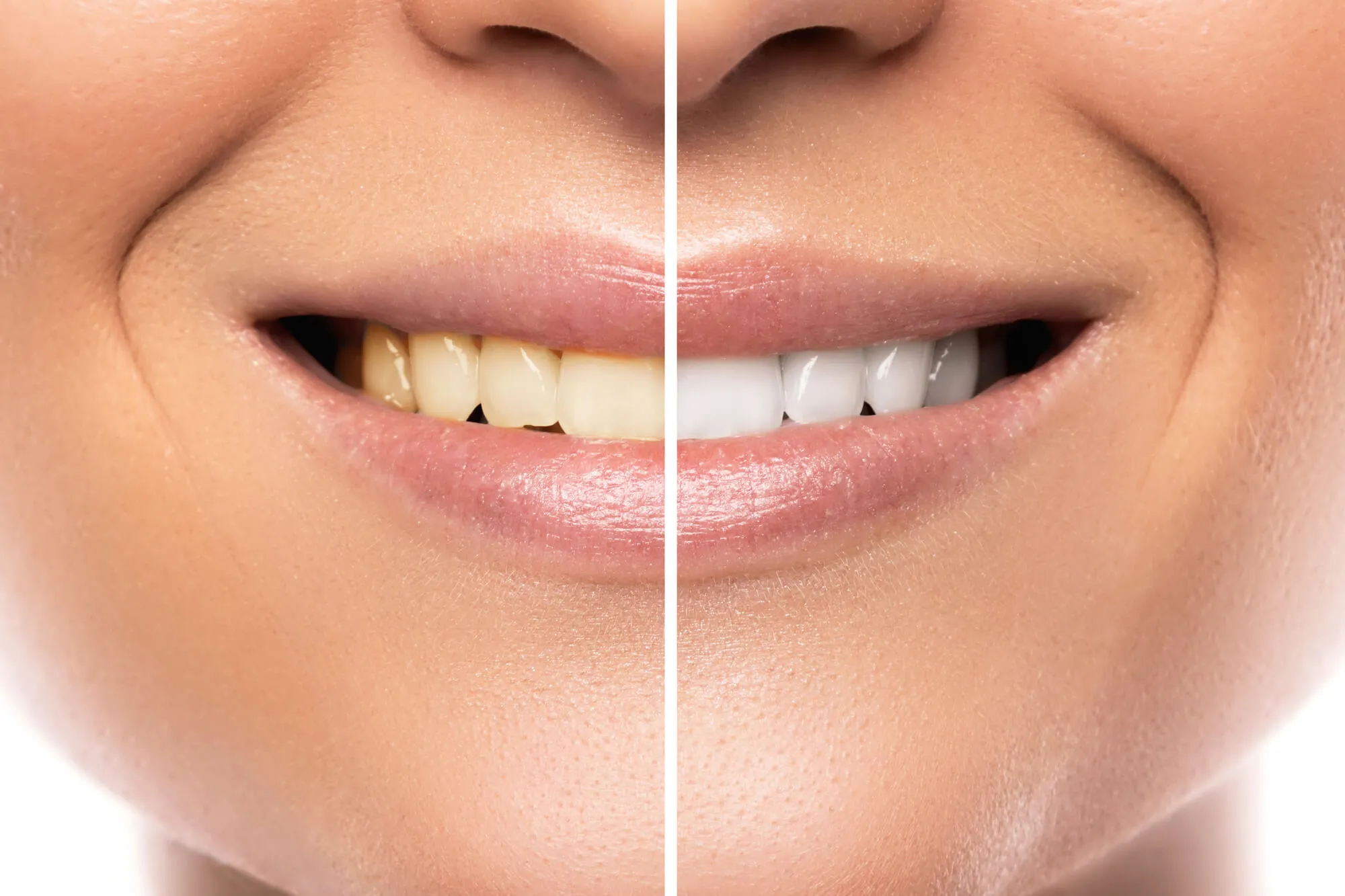 24960 teeth whitening maintenance