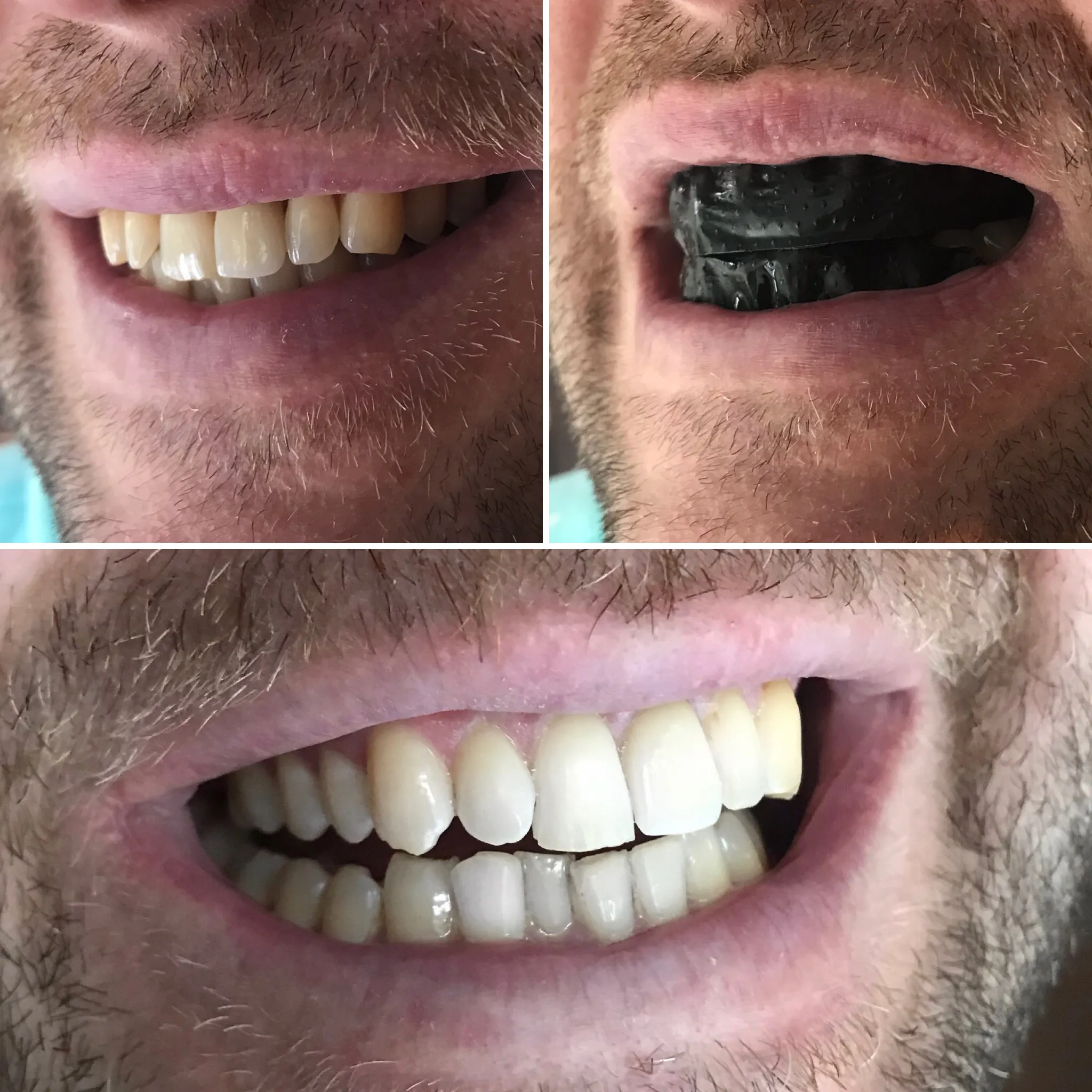 24964 applying whitening strips