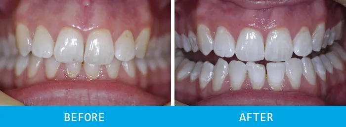24964 sensitive teeth