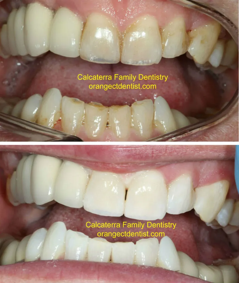 24968 ct teeth whitening diet