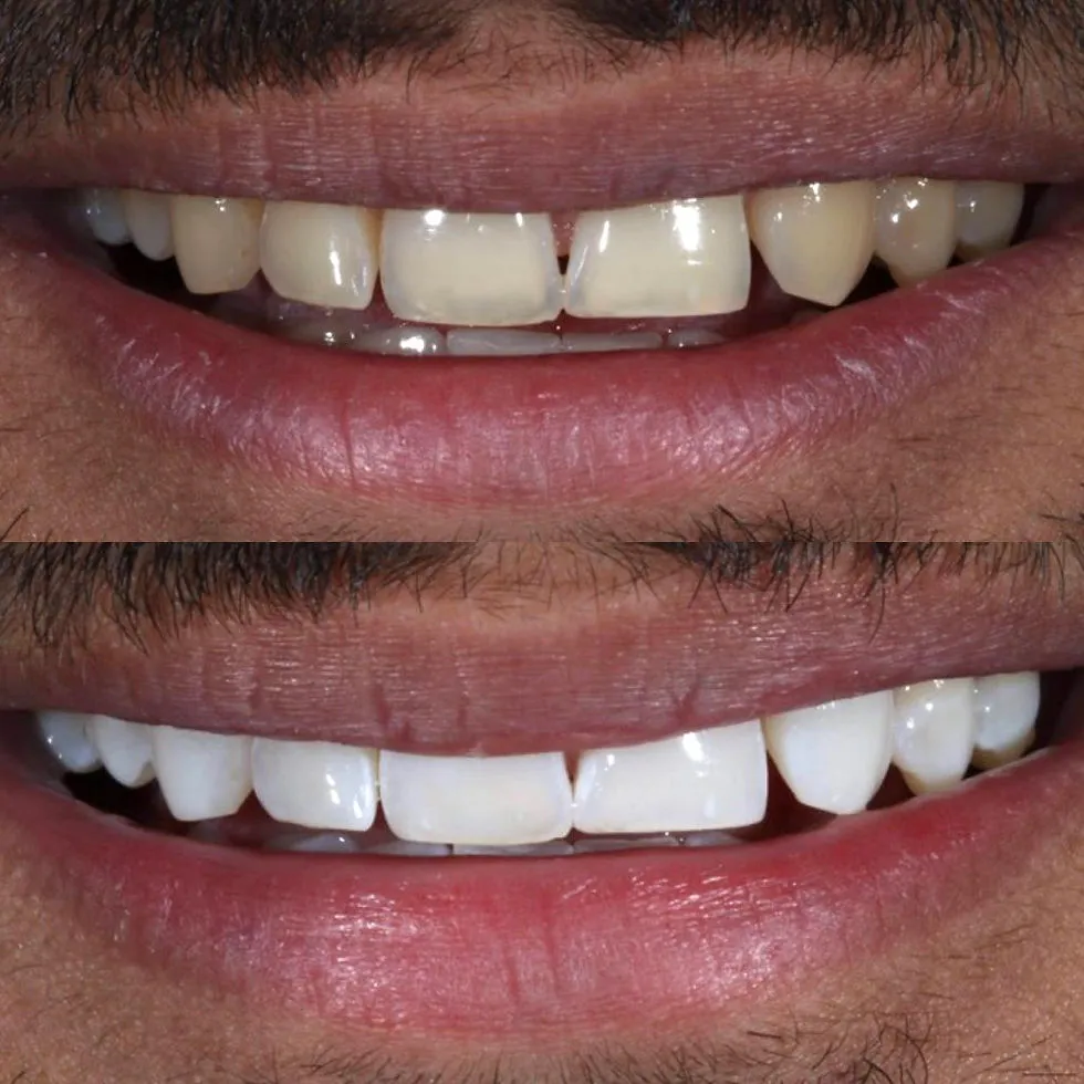 /img/24968-ct-teeth-whitening-maintenance.webp