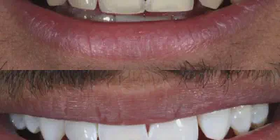 /img/24968-ct-teeth-whitening-maintenance.webp