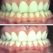24980 cosmetic whitening procedure