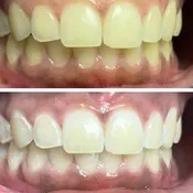 24980 guven cosmetic whitening smile