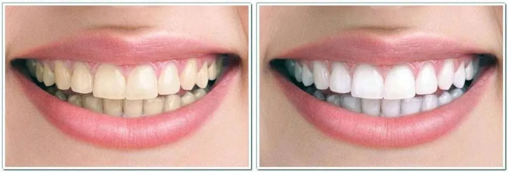 24984 foods to avoid teeth whitening