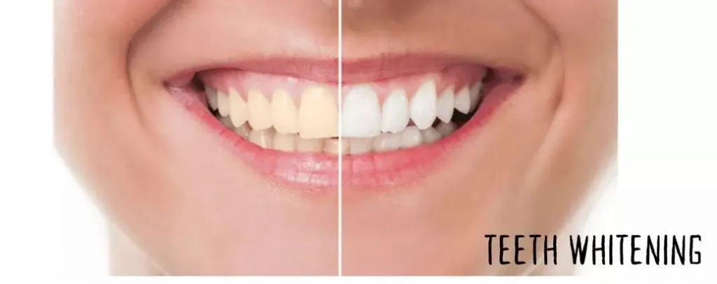 24984 teeth whitening bulimba overview