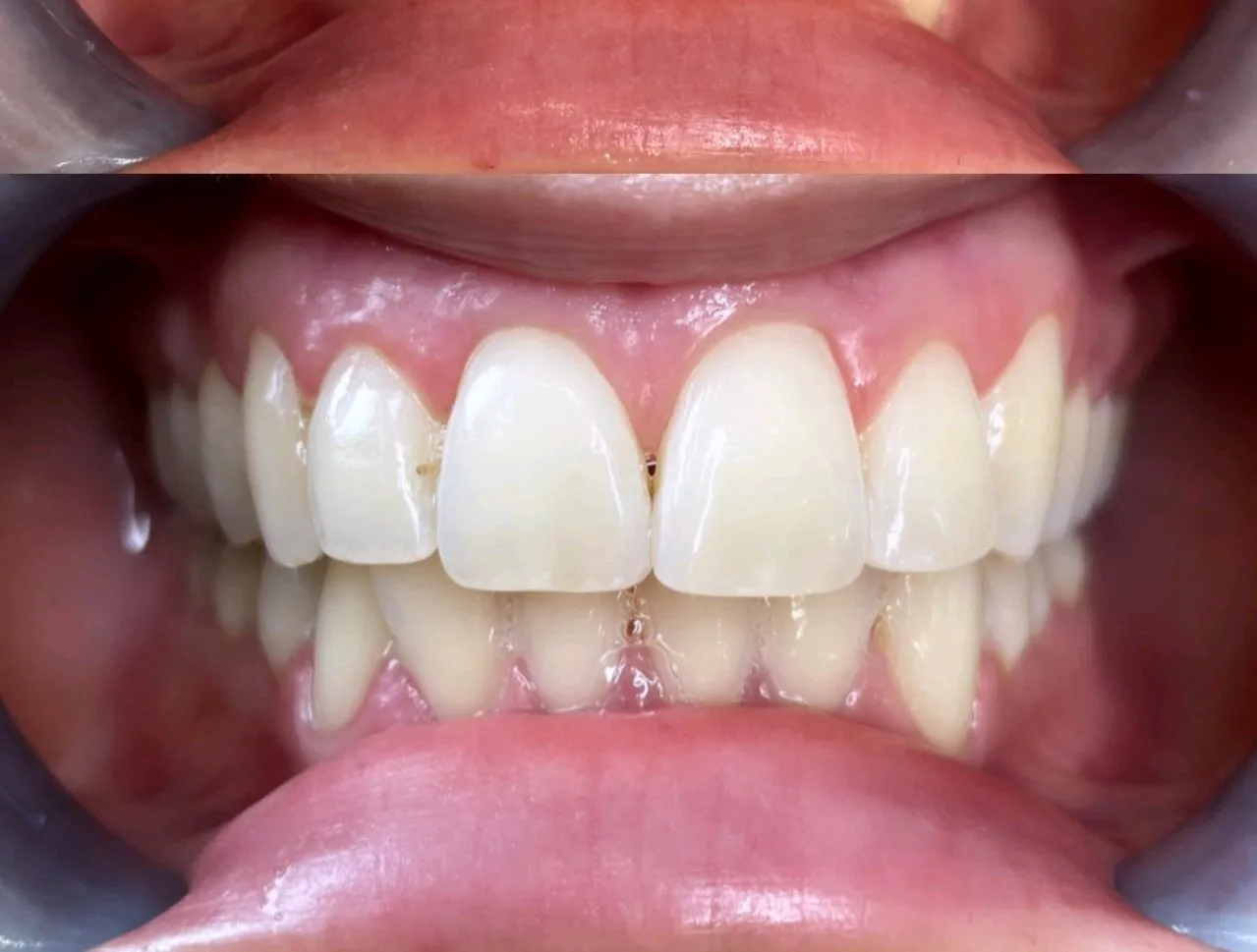 24984 teeth whitening options