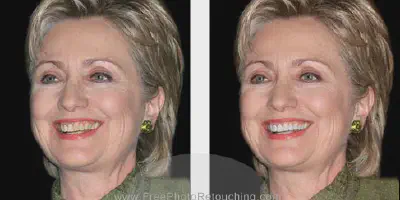 /img/24986-before-after-teeth-whitening.webp