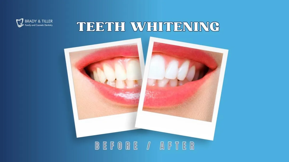 24989 teeth whitening options fayetteville