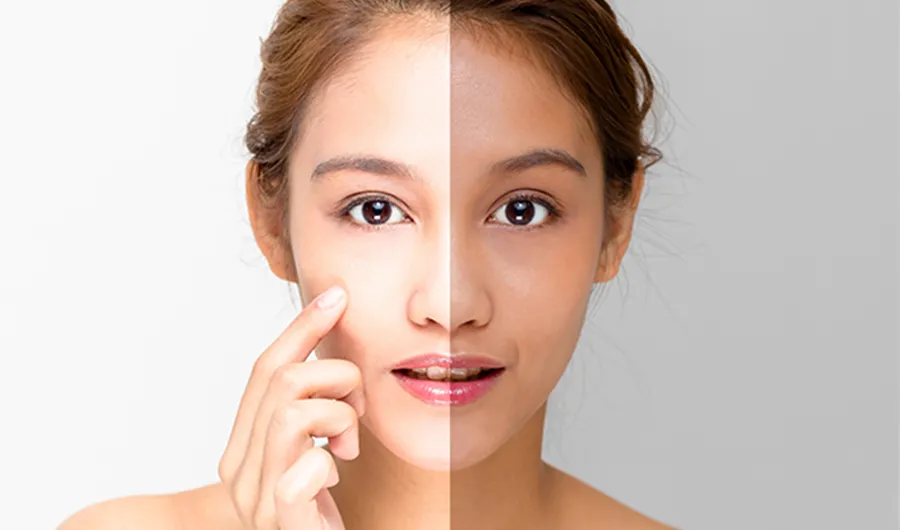 24993 eczema skin whitening
